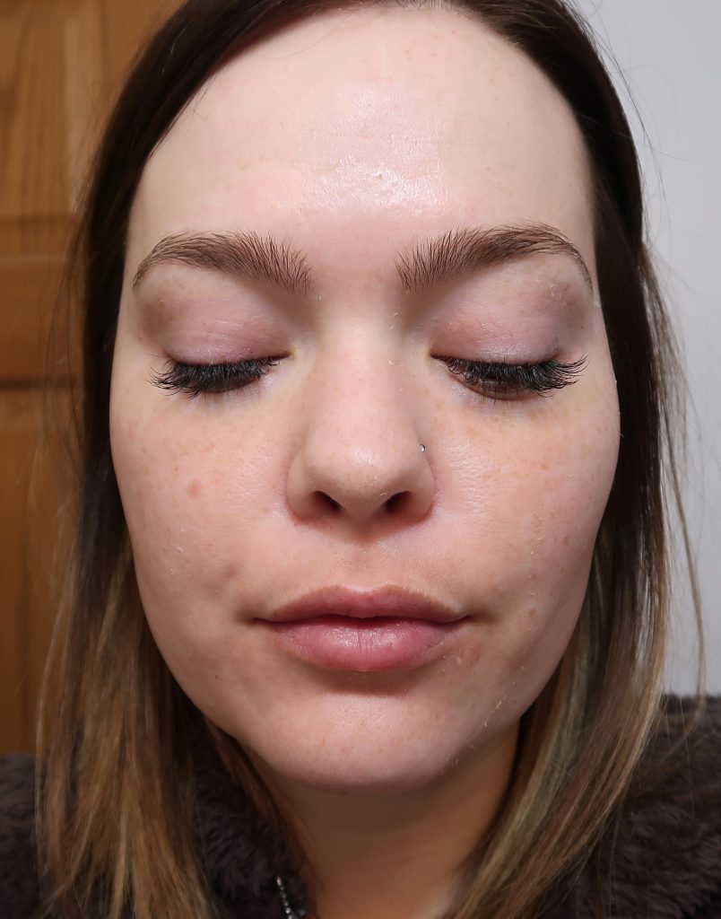 Chemical Peel | Experience & Results - Kelsie Kristine