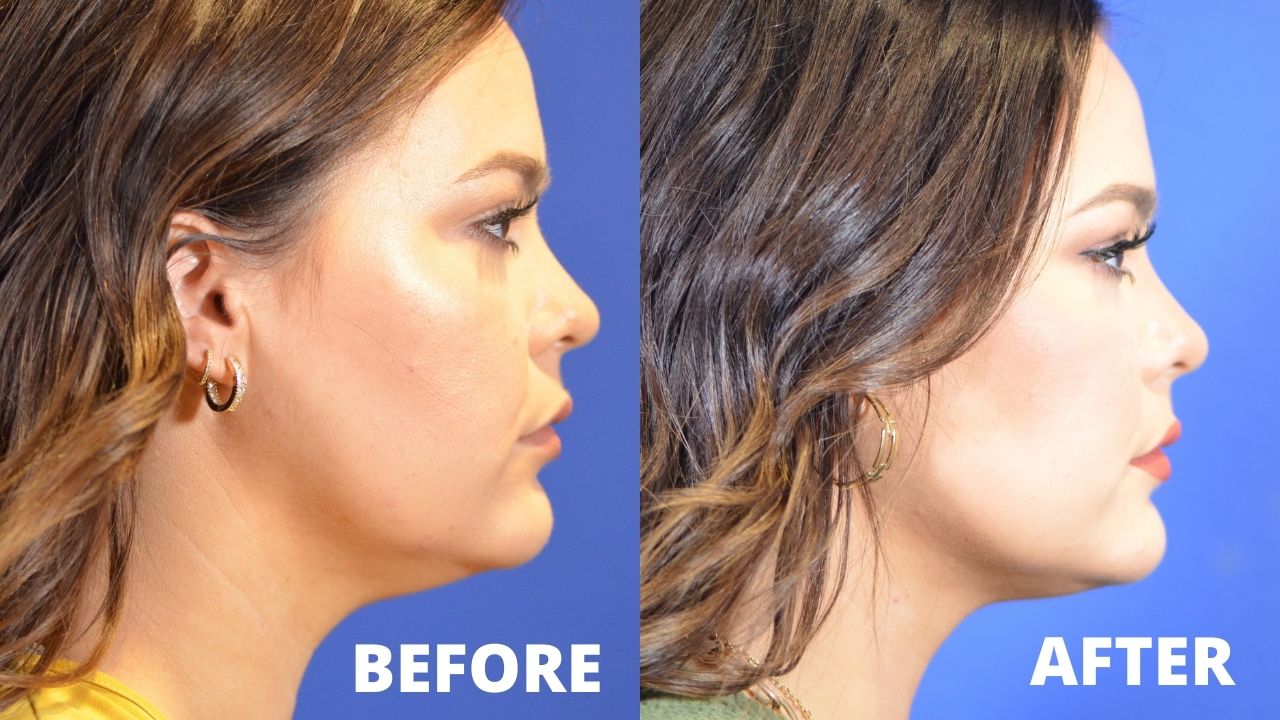 CoolSculpting Chin - Does it really work on Double Chin?