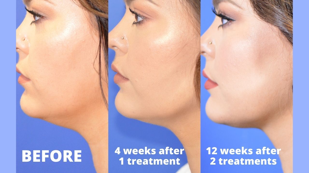 CoolSculpting Under Chin Amazing Results