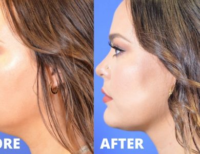 double chin coolsculpting
