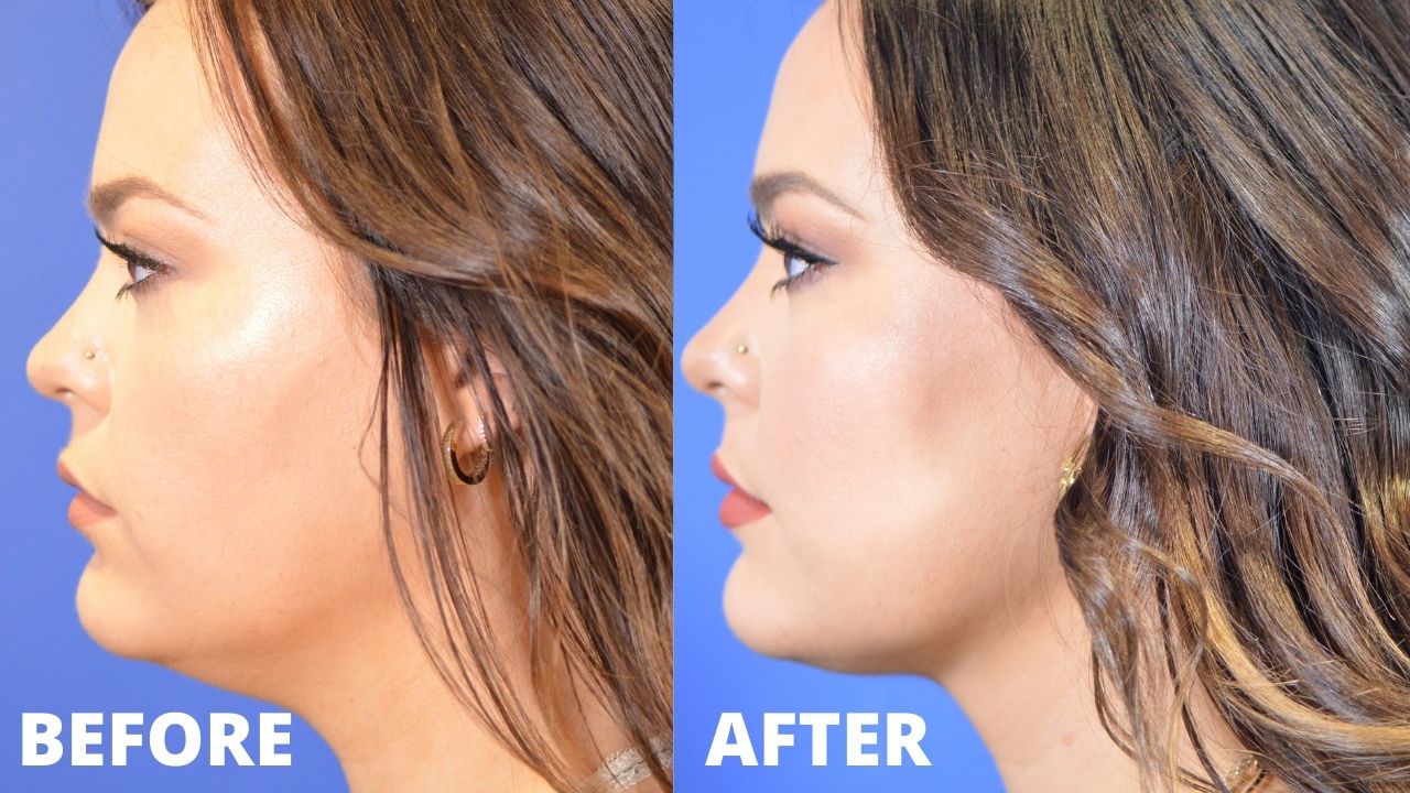 Chin Sculpting, Permanent Double Chin Removal